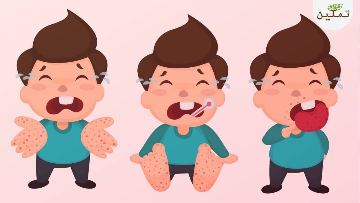 متلازمة الفم واليد والقدم