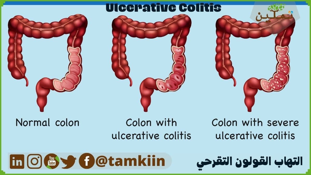 التهاب القولون