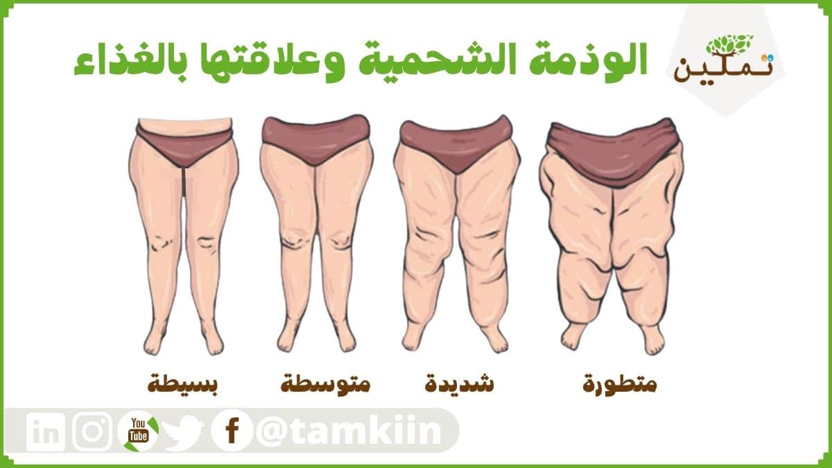 الوذمة الشحمية